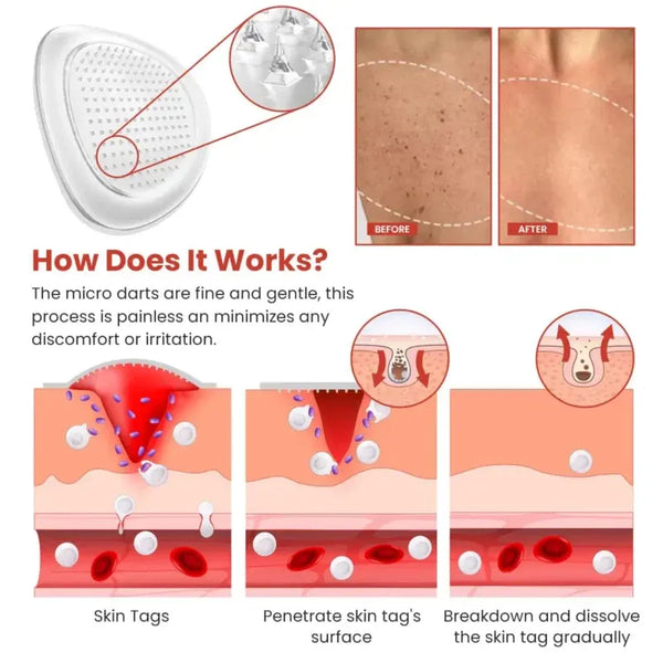 Derma Smooth Skin Tag Removal Patch | Buy 1 Get 1 Free |