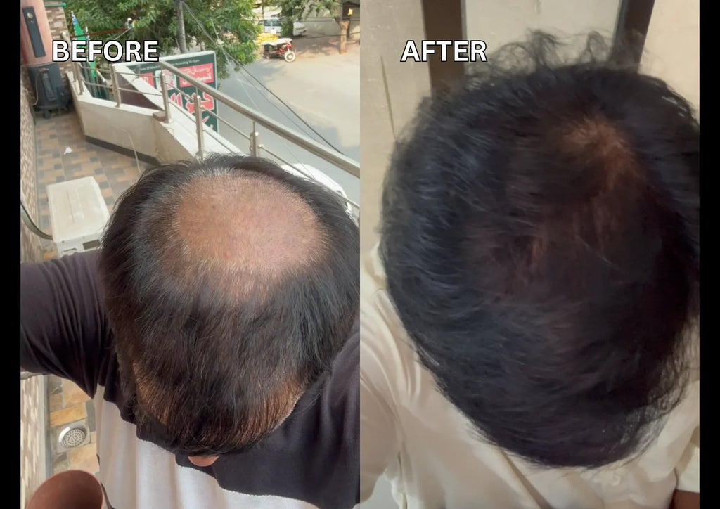 Best Hair Oil in Pakistan – Regrowth Hair Oil